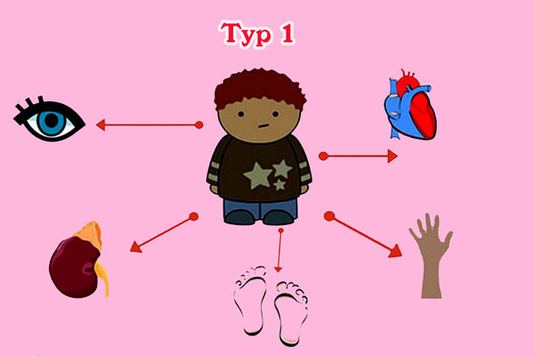 Bệnh đái thảo đường typ 1