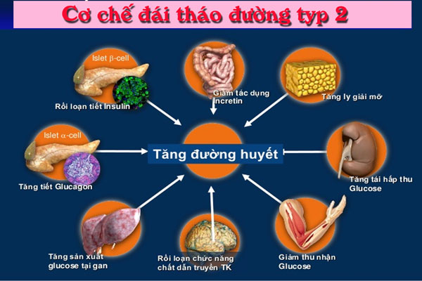 Đái tháo đường typ2